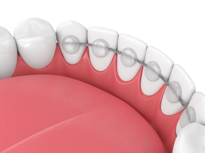 a permanent retainer bonded to the back of the bottom front teeth